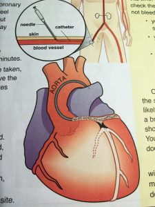 heart - angiogram