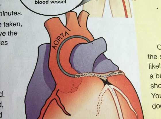 heart - angiogram